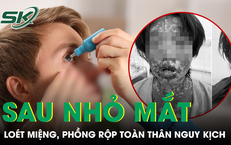 Loét miệng chảy máu, phồng rộp toàn thân nguy kịch sau khi tự dùng thuốc nhỏ mắt