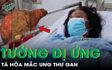 Ngứa 2 chân tưởng dị ứng, tá hỏa phát hiện mắc ung thư gan