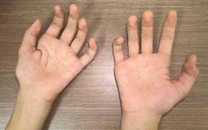 Teo cơ bàn tay ở người trẻ: Cảnh giác với bệnh Hirayama hiếm gặp