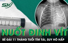 Bé gái 11 tháng tuổi tím tái, suy hô hấp sau khi nuốt đinh vít dài 4 cm