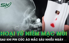 Bé trai 4 tuổi hoại tử niêm mạc mũi vì pin cúc áo mắc sâu nhiều ngày