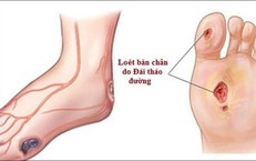 Tê rần bàn chân ở người tiểu đường cần chú ý biến chứng thần kinh