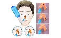 Vệ sinh mũi đúng cách