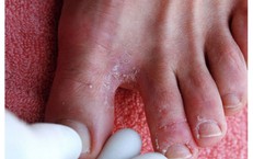 Bệnh ngoài da hay gặp mùa mưa bão