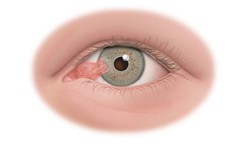 7 dấu hiệu nhận biết xước, rách giác mạc