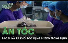 Bé gái ăn tóc nhiều năm, bác sĩ lấy ra khối tóc nặng 0,25 kg trong bụng
