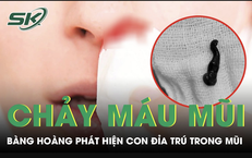 Chảy máu mũi suốt một tháng nam thanh niên phát hiện con đỉa trú trong mũi
