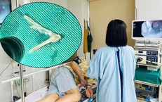 Xương ghẹ chắn ngang thực quản cụ ông 81 tuổi