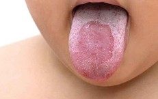 Những yếu tố làm tăng nguy cơ mắc lưỡi bản đồ