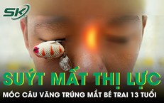 Móc câu văng trúng mắt, bé trai 13 tuổi suýt mất thị lực