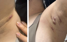 Viêm tuyến mồ hôi mủ dễ nhầm với mụn nhọt, áp xe
