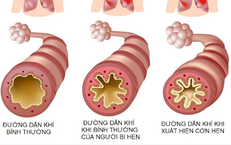 Phòng tránh cơn hen cấp lúc giao mùa