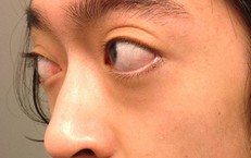 Lồi mắt Basedow cần làm gì?