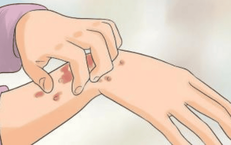 6 cách để giảm khó chịu, hỗ trợ kiểm soát viêm da thần kinh hiệu quả