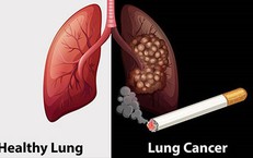 70-80% bệnh nhân ung thư phổi tại Việt Nam được chẩn đoán ở giai đoạn muộn