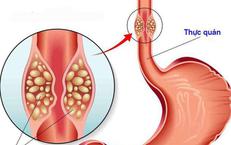 Triệu chứng hẹp thực quản: Đừng chủ quan khi thường xuyên nuốt nghẹn