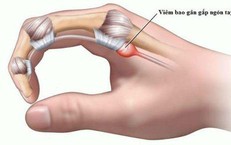 Ngón tay đau hoặc bật lò xo, cảnh giác với viêm gân gấp ngón tay