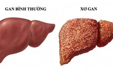 Chưa bị xơ gan vẫn có thể mắc ung thư gan