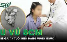 Bé gái 14 tuổi có khối u vú 8cm gây biến dạng