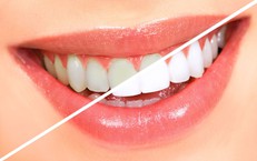 Thói quen xấu làm hại men răng thường gặp