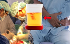 Người đàn ông phải cắt bỏ bàng quang vì một dấu hiệu bị bỏ qua quá lâu