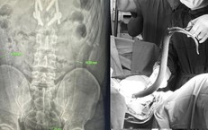 Nhét lươn sống dài nửa mét vào hậu môn, người đàn ông suýt thủng ruột
