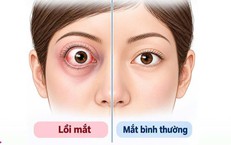 Mắt lồi, mất thị lực do khối u nằm sâu sau nhãn cầu