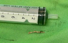Mắc xương cá, người đàn ông phải cắt bỏ tuyến dưới hàm