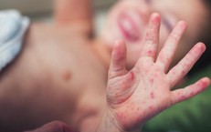 Tay chân miệng gia tăng, cha mẹ cần làm gì để bảo vệ trẻ khỏi nguồn lây?