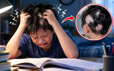 Ôn thi căng thẳng, bé trai tự nhổ tóc đến trơ từng mảng da đầu