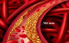 5 lưu ý khi điều trị mỡ máu tại nhà