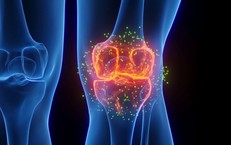 Cảnh báo loại thực phẩm gây nguy cơ tích mỡ vùng đùi và thoái hóa khớp