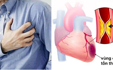 Nhồi máu cơ tim cấp do tắc mạch vành ở người hút thuốc lá nhiều năm