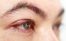 Những yếu tố làm tăng nguy cơ lẹo mắt