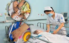 Gần 1/3 ca tay chân miệng nhập viện là ca nặng, bệnh viện dự phòng hơn 100 giường