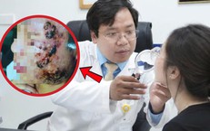 Tin lời sạch mụn sau 3 ngày, nữ sinh 20 tuổi mặt sưng nề 'như ong đốt'