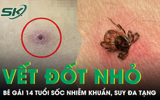 Bé gái 14 tuổi sốc nhiễm khuẩn, suy đa tạng từ một vết đốt dưới ngực