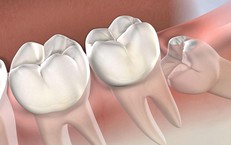 Răng số 8 mọc lệch có thể gây biến chứng gì?