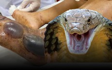 9 người bị rắn độc cắn may mắn thoát 'cửa tử' nhờ huyết thanh kháng nọc