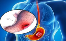 6 dấu hiệu cảnh báo ung thư dạ dày cần biết