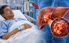 Ung thư gan ‘nhắm’ đến ai, yếu tố nguy cơ cần đặc biệt lưu ý