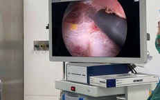 Phẫu thuật nội soi tuyến giáp – thêm lựa chọn cho bệnh nhân tại BV Bạch Mai cơ sở Ninh Bình