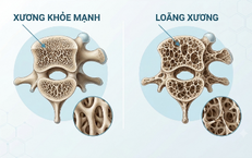 Nguy cơ gây loãng xương: Trường hợp nào cần chủ động đánh giá sức khỏe xương?