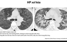 Ho khan, khó thở kéo dài: Cảnh giác với bệnh phổi kẽ