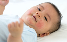 Làm sao biết con bạn bị dị ứng sữa?