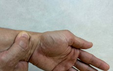  4 nguyên nhân gây đau cổ tay