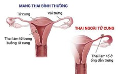 Thử thai 2 vạch, vì sao cần phải đi siêu âm sớm?