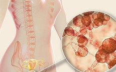Mẹ bầu mắc nấm âm đạo nên uống thuốc hay đặt thuốc?