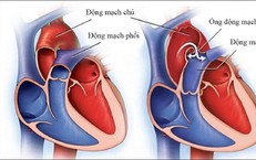 4 dấu hiệu bệnh tim bẩm sinh ở trẻ cha mẹ cần lưu ý