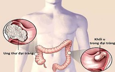 Ung thư đại trực tràng thường di căn đến đâu?